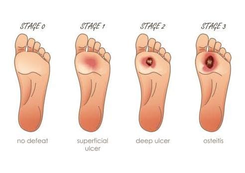Diabetic Foot Infection & Chronic Wounds: Causes, Care, and Healing Tips