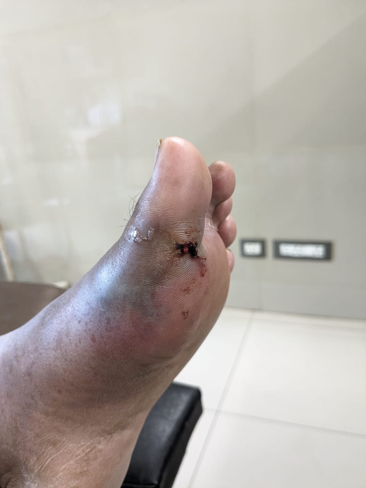 Spreading infection.