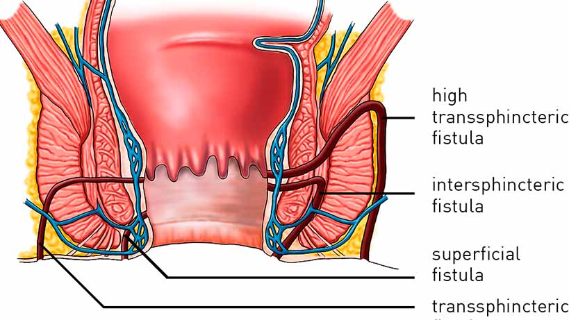 Fistula in Ano, Piles & Fissures